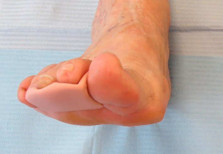 Tratamiento del pie diabético en Ondara