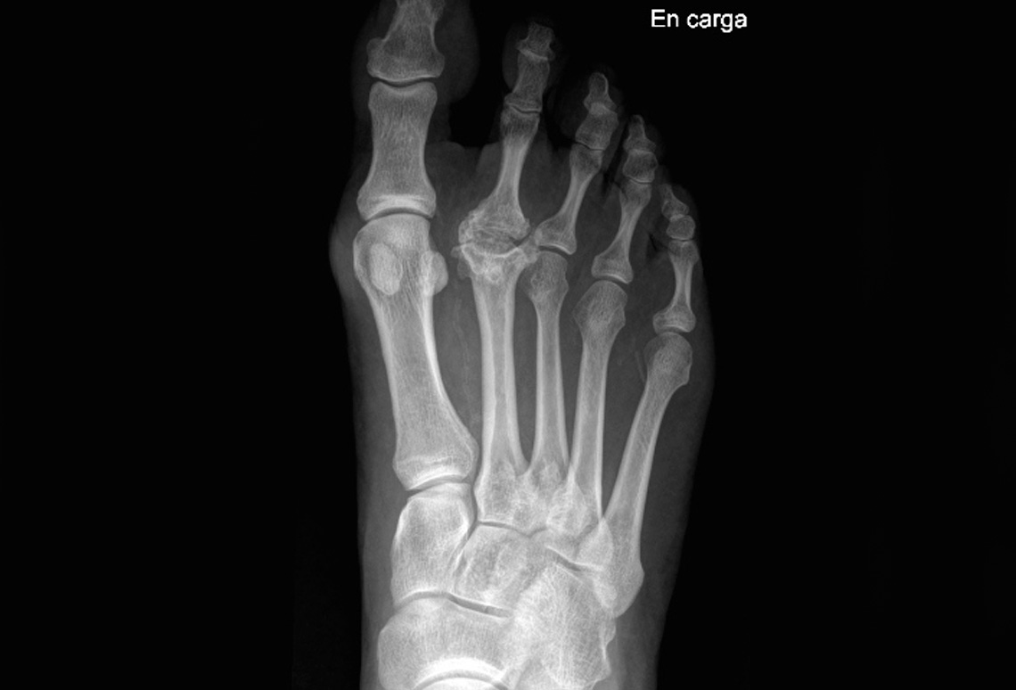 Enfermedad de Freiberg o Osteocondritis Metatarsal en Ondara