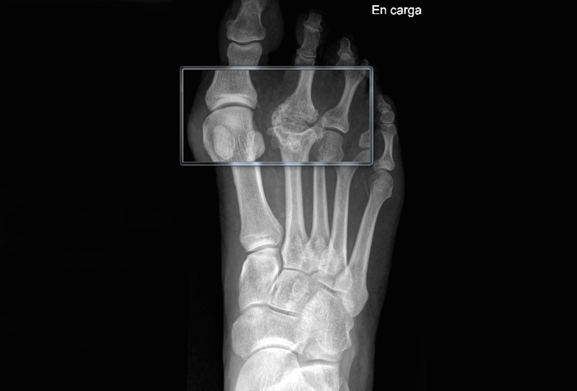 Enfermedad de Freiberg o Osteocondritis Metatarsal en Ondara