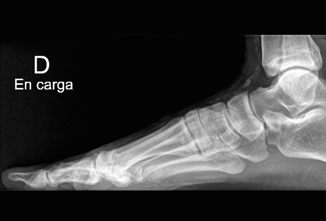 Enfermedad de Freiberg o Osteocondritis Metatarsal en Ondara