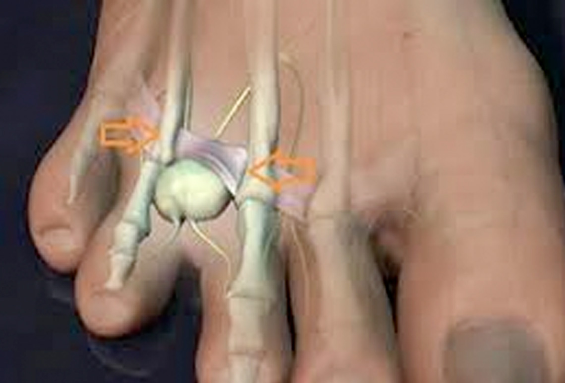 Neuroma de Morton en Ondara