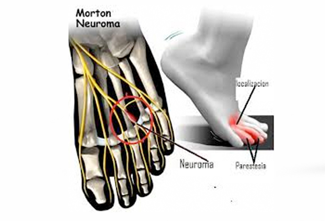 Neuroma de Morton en Ondara