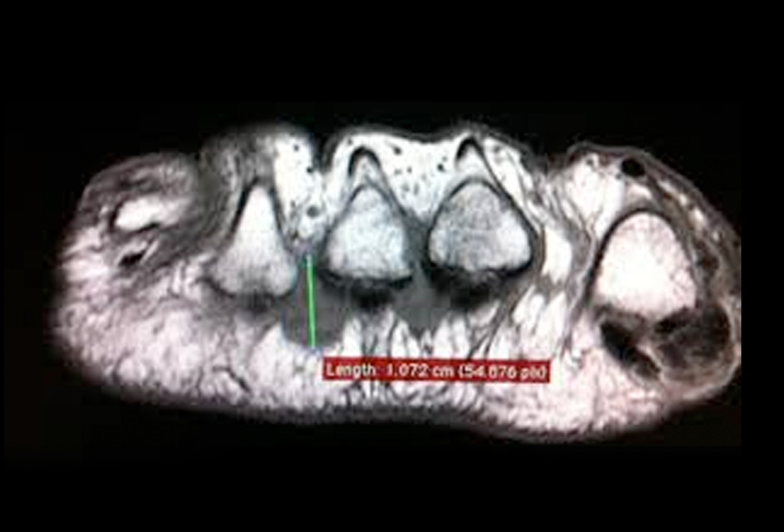 Neuroma de Morton en Ondara