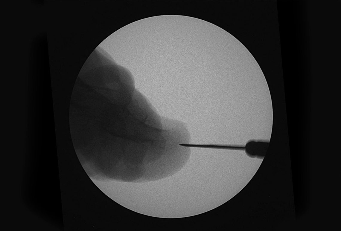 Uña encarnada, Exostosis Subungueal, Osteocondroma Subungueal en Ondara