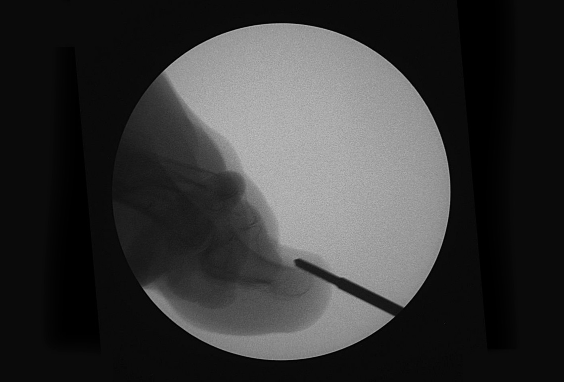 Uña encarnada, Exostosis Subungueal, Osteocondroma Subungueal en Ondara